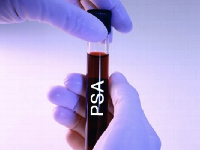 Do you really need that PSA test for prostate cancer?