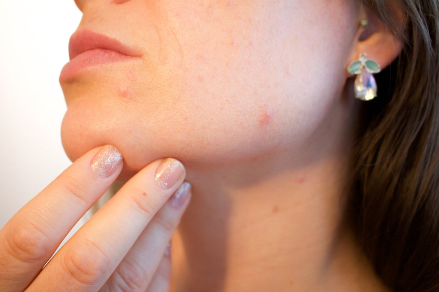 Woman with blemishes on her chin