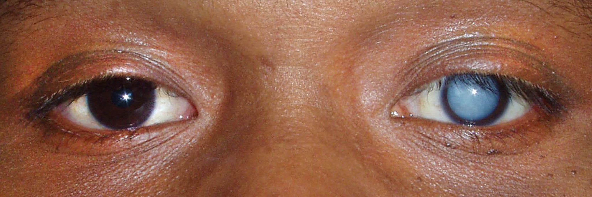 Ginger for cataract prevention