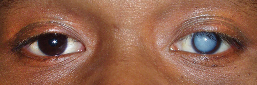 Ginger for cataract prevention